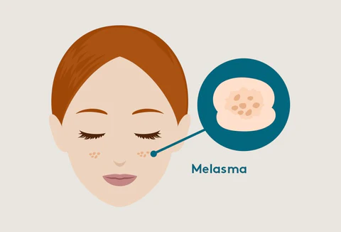 Melasma