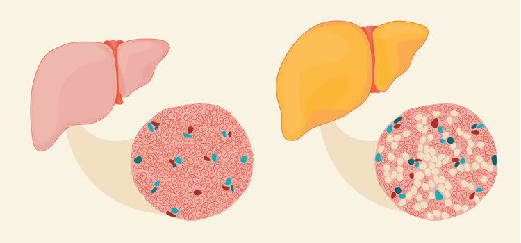 Liver Disease